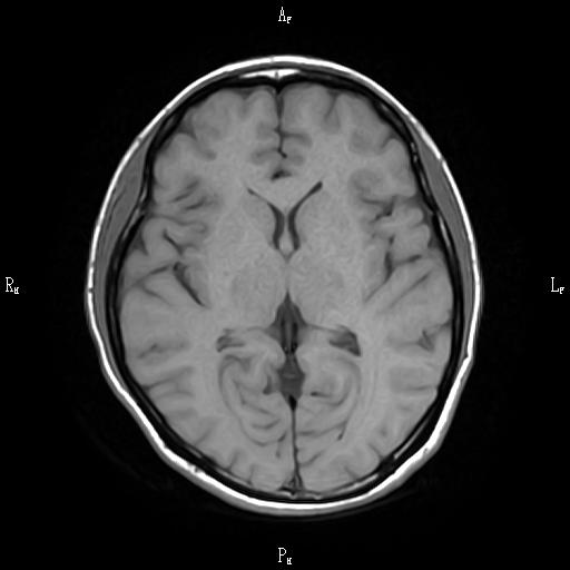 正常な脳(T1W1)