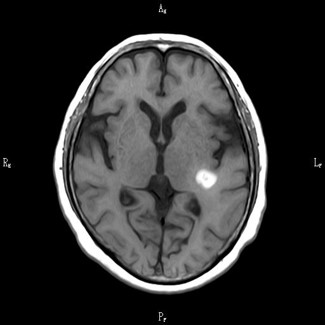 脳腫瘍(T1W1)